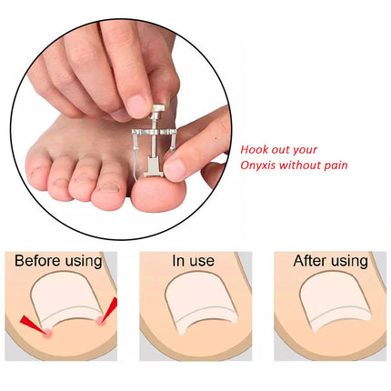 Ingrown Toenail Kit